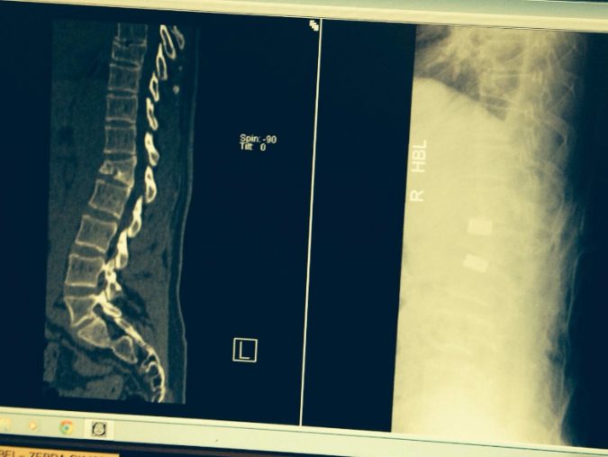 Wedge Fracture